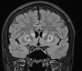 MRI scan of a brain affected by Wilson Disease