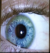 Image of an eye affected by Wilson Disease