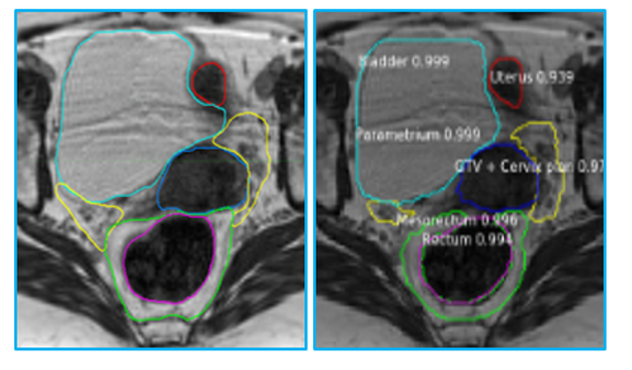 Radiation oncology example of imaging