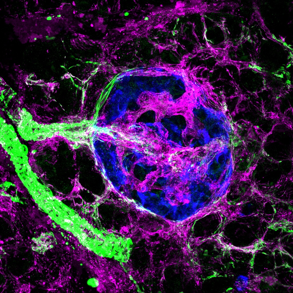 Islet from an autoantibody positive donoar