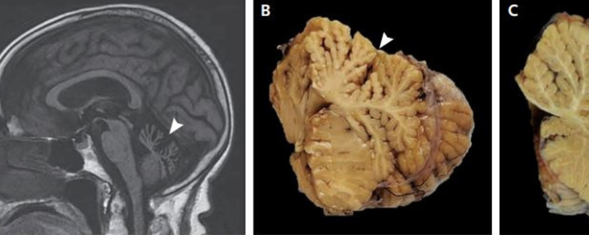 Genetic Anomaly Behind Common Late-Onset Cerebellar Ataxia