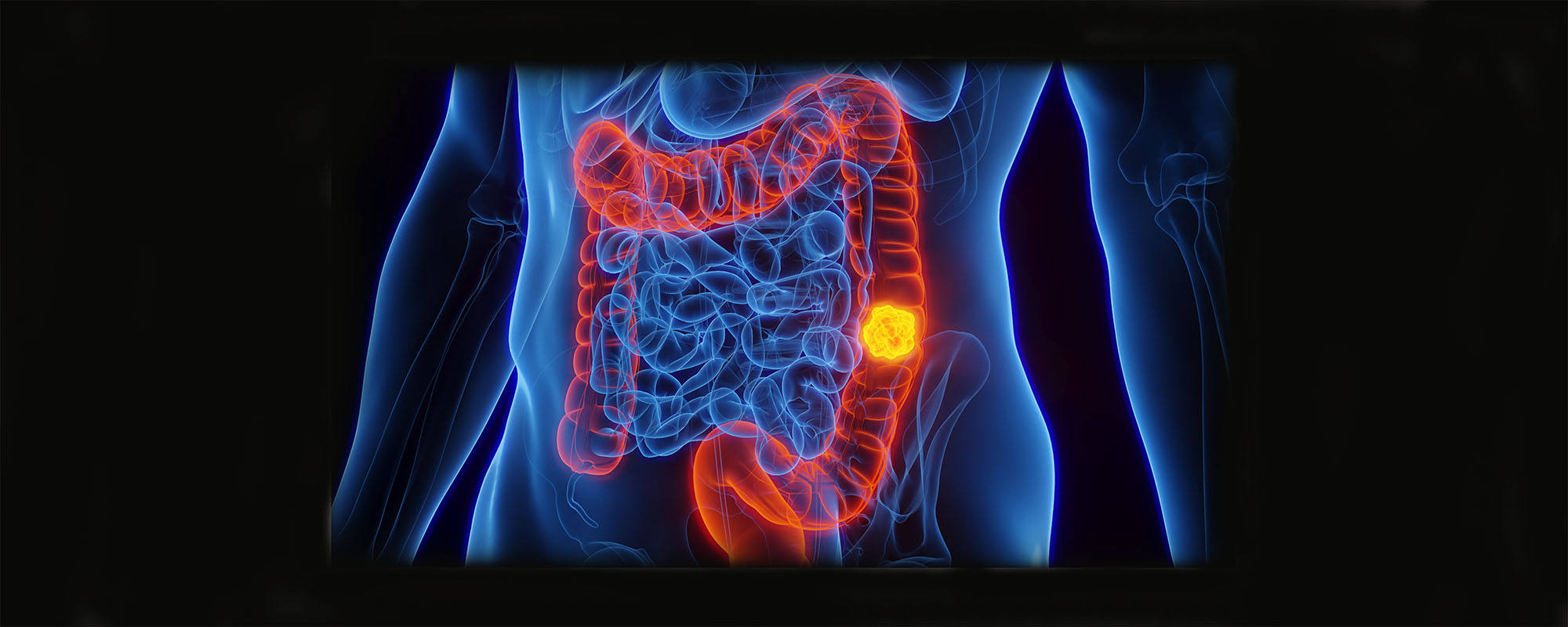 Medical illustration of cancer in the colon