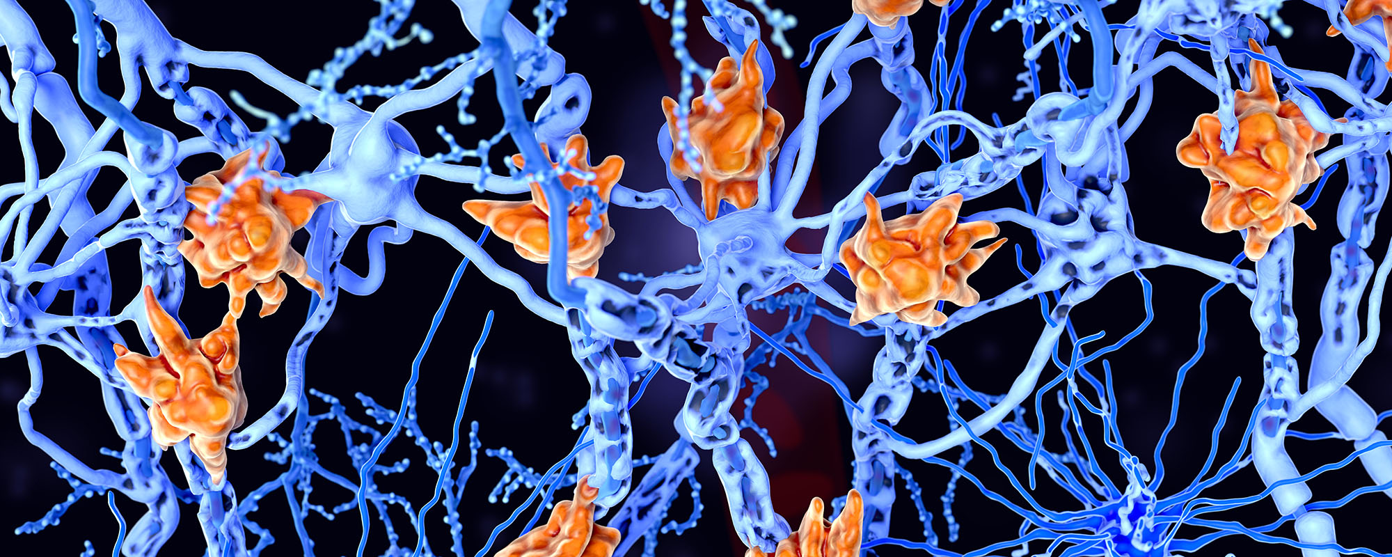 Image of damaged nerve cells