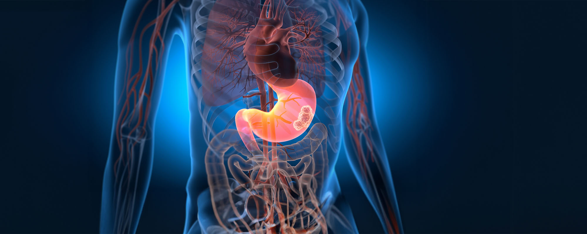 Illustration of cancer cells in the stomach